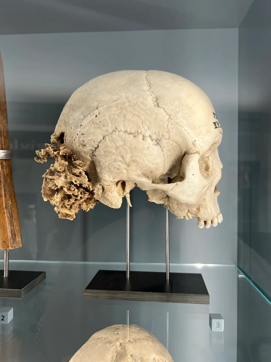 Narrenturm - Pathologisch-anatomische Sammlung