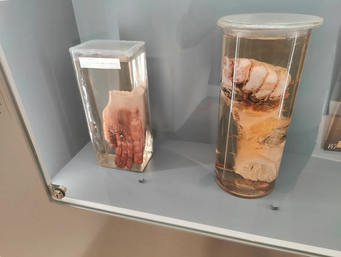 Narrenturm - Pathologisch-anatomische Sammlung